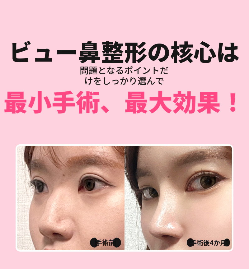 ❤️ビュー❤️わし鼻整形