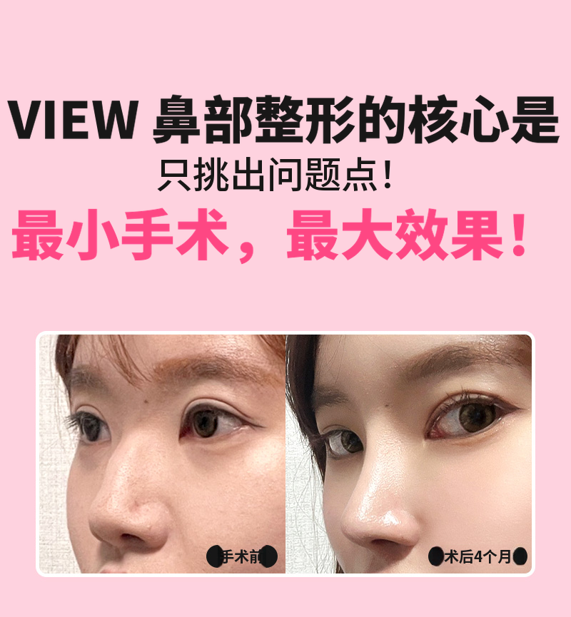 ❤️视图❤️鹰钩鼻整形