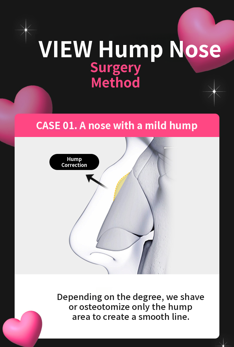 ❤️View❤️Nasal Surgery