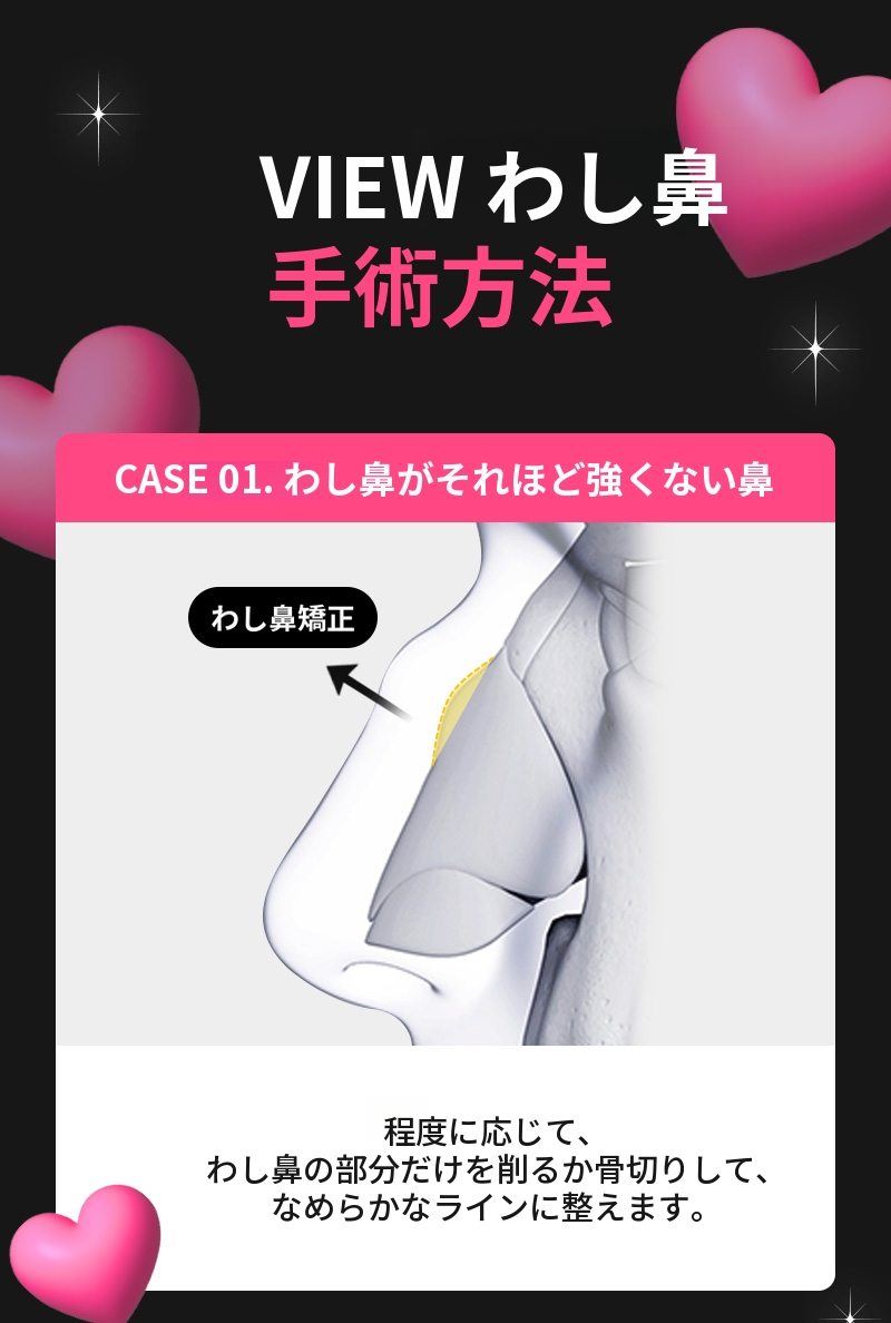 ❤️ビュー❤️わし鼻整形