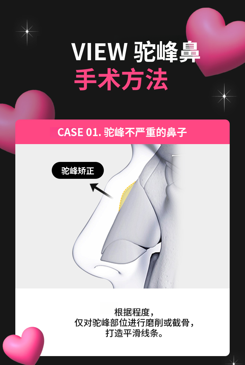 ❤️视图❤️鹰钩鼻整形