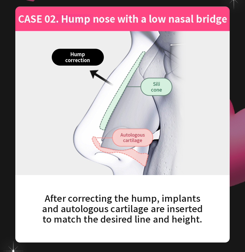 ❤️View❤️Nasal Surgery
