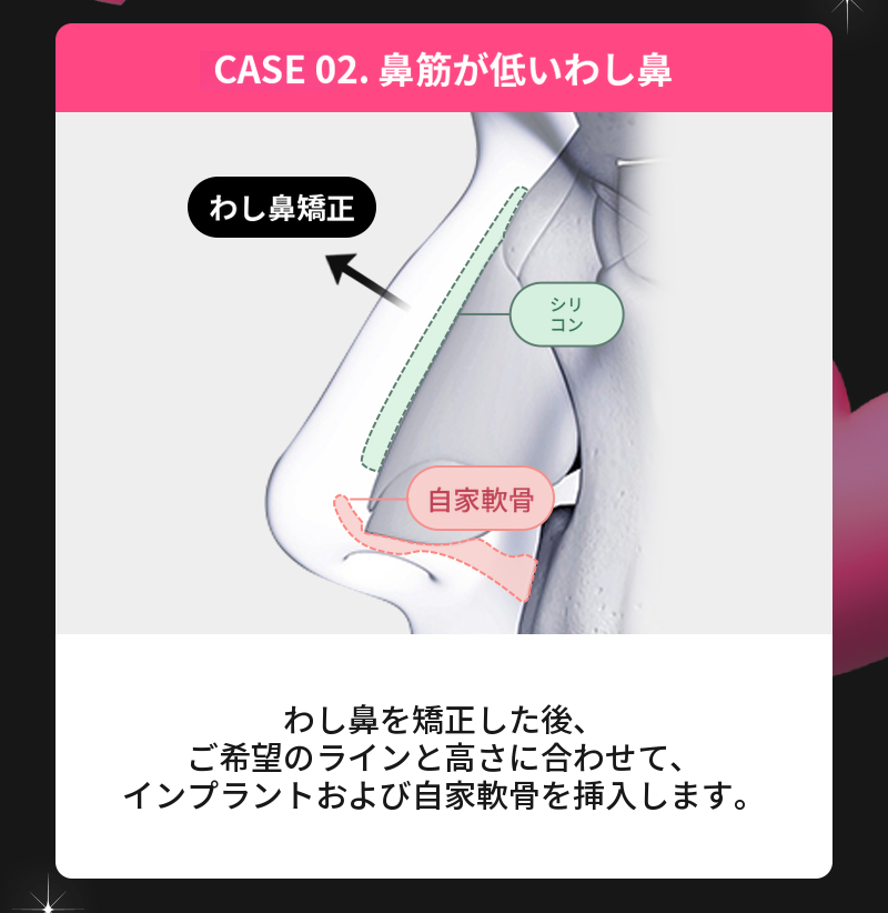 ❤️ビュー❤️わし鼻整形