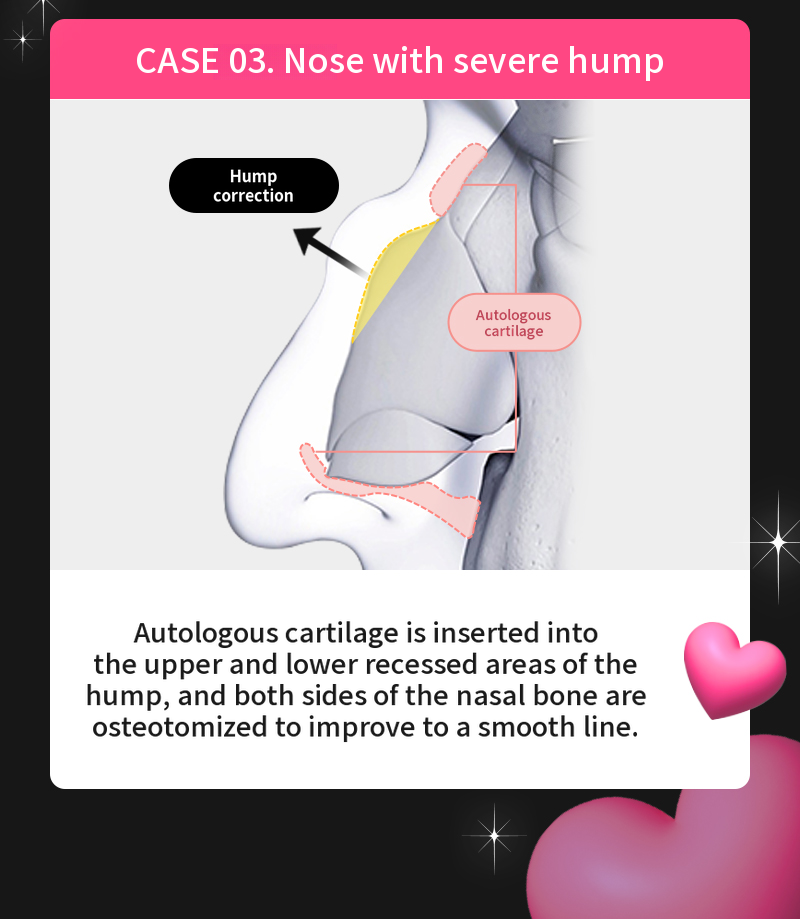 ❤️View❤️Nasal Surgery