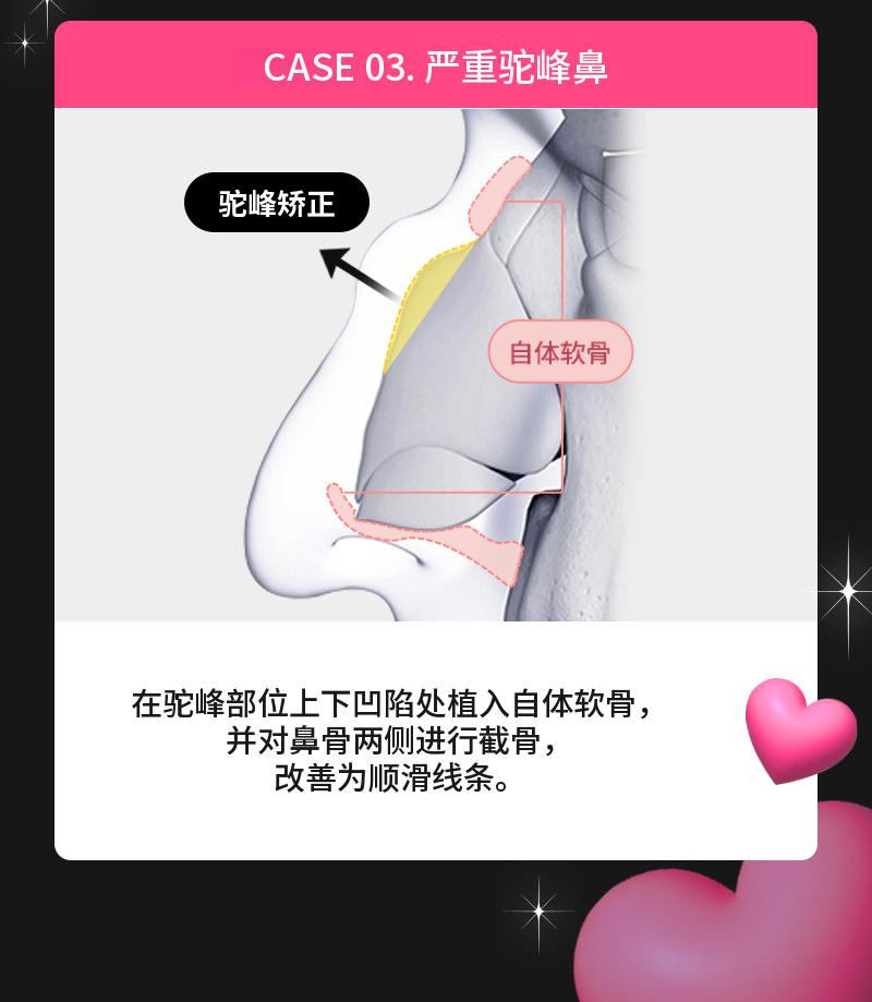 ❤️视图❤️鹰钩鼻整形