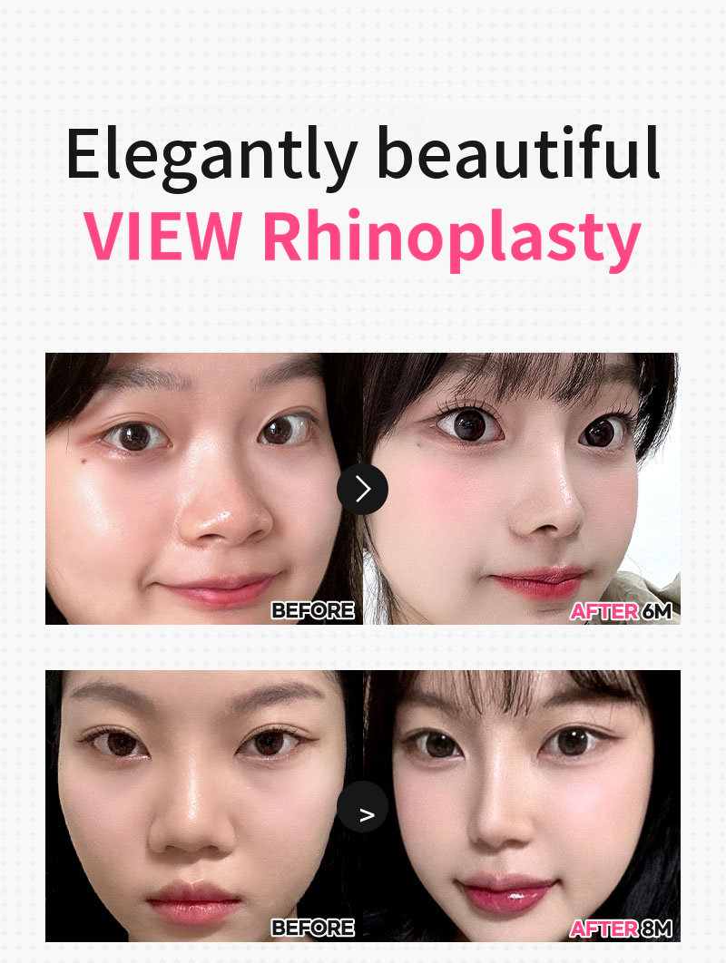 ❤️View❤️Nasal Surgery