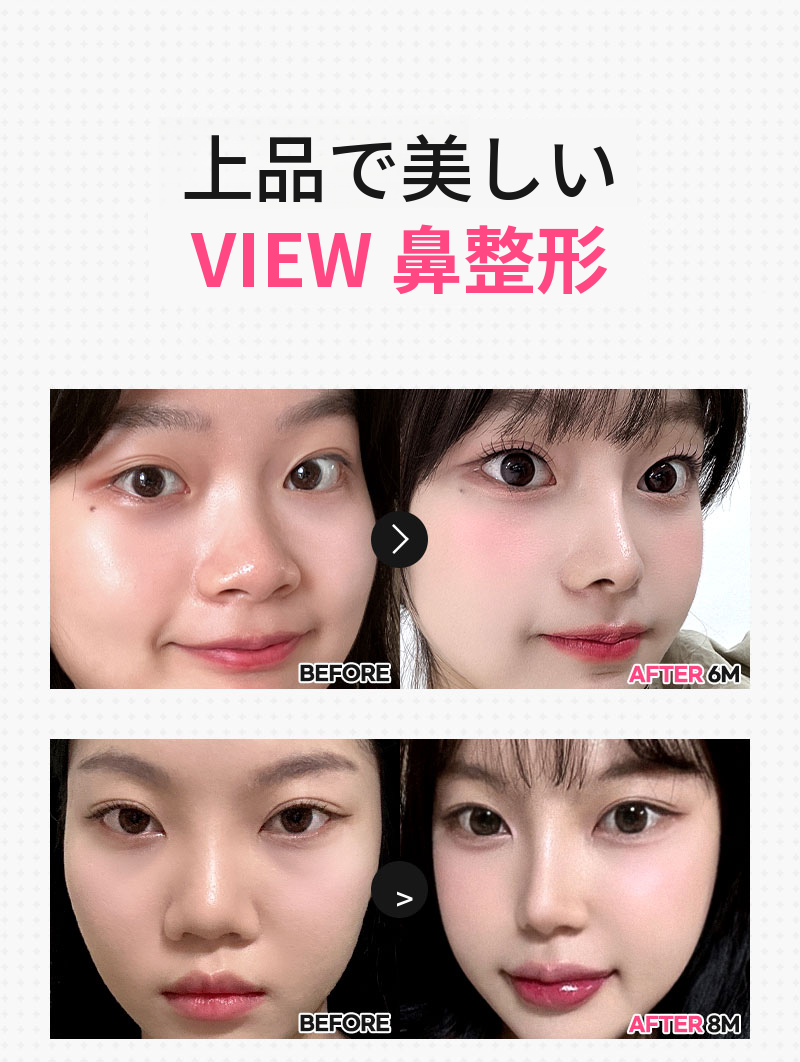 ❤️ビュー❤️わし鼻整形