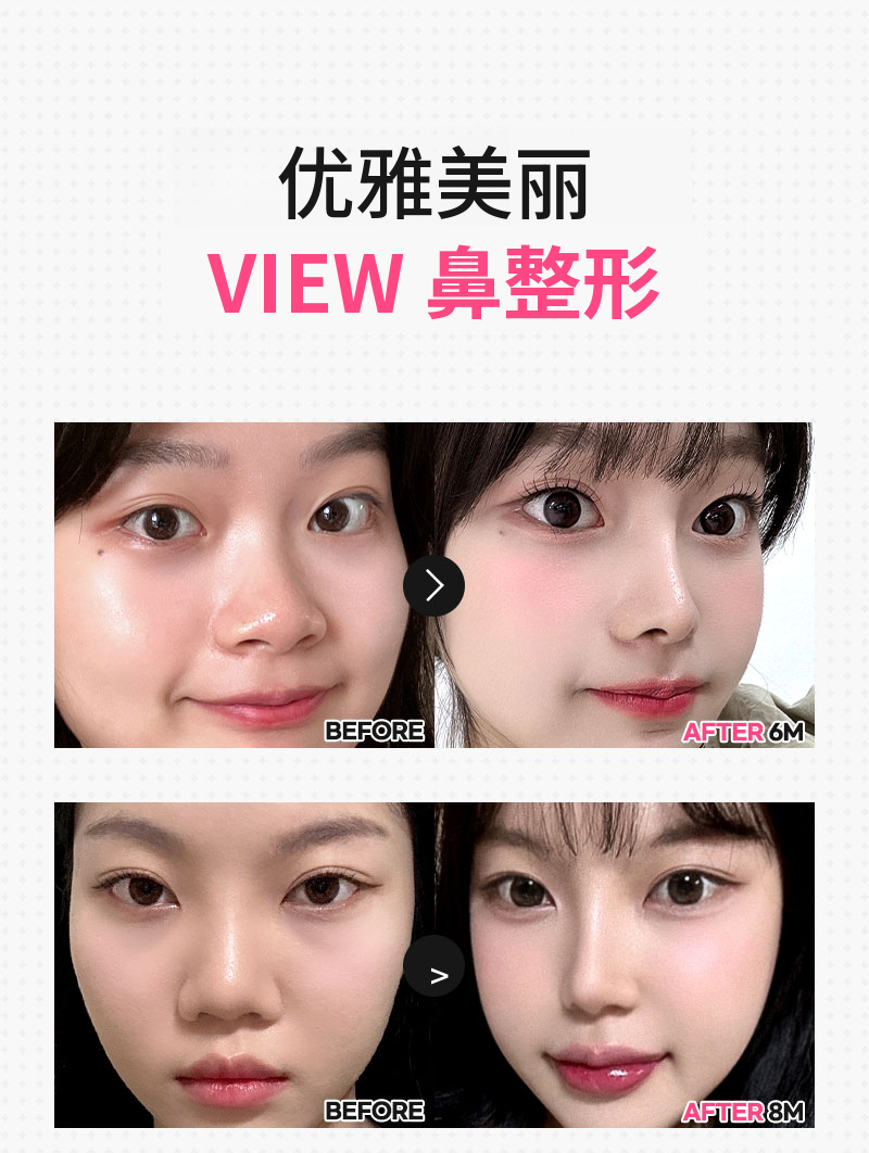 ❤️视图❤️鹰钩鼻整形