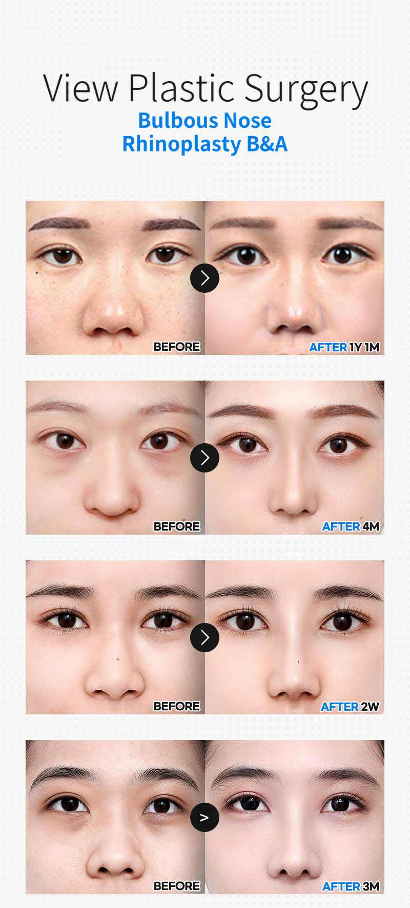 ❤️View❤️Nose Reshaping