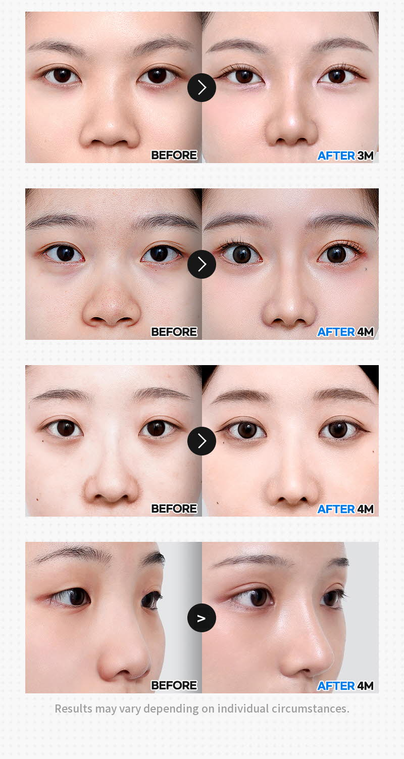❤️View❤️Nose Reshaping