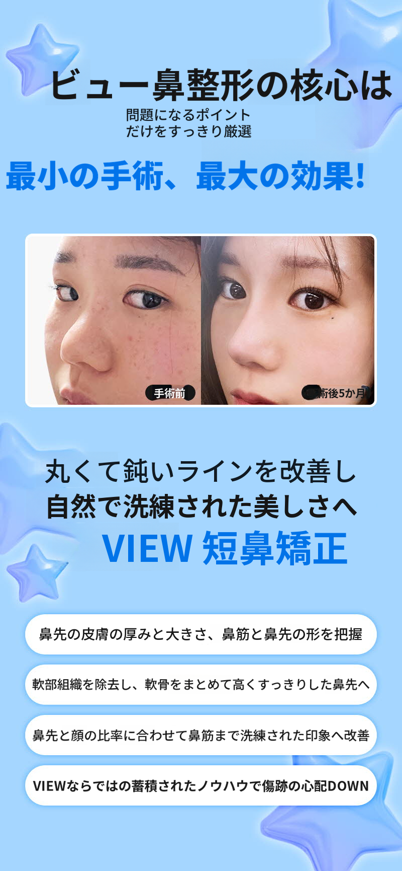 ❤️ビュ❤️鼻整形