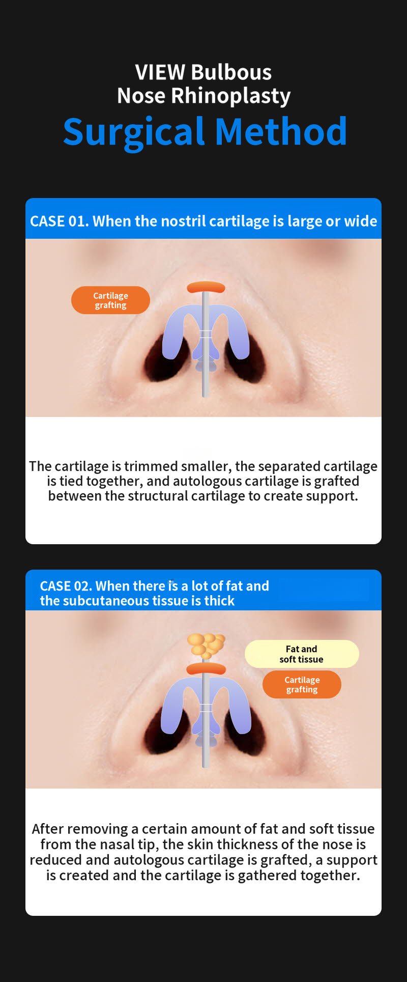 ❤️View❤️Nose Reshaping