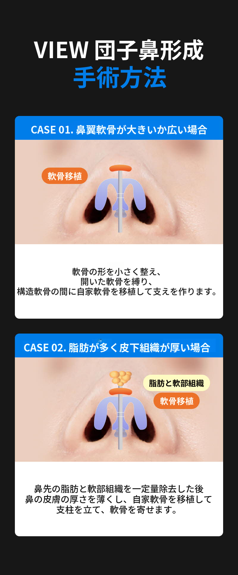 ❤️ビュ❤️鼻整形