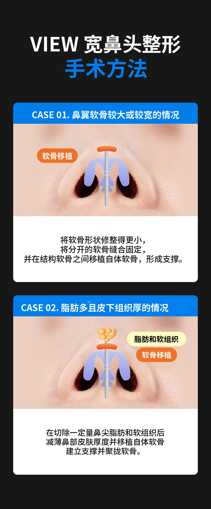 ❤️视❤️鼻整形