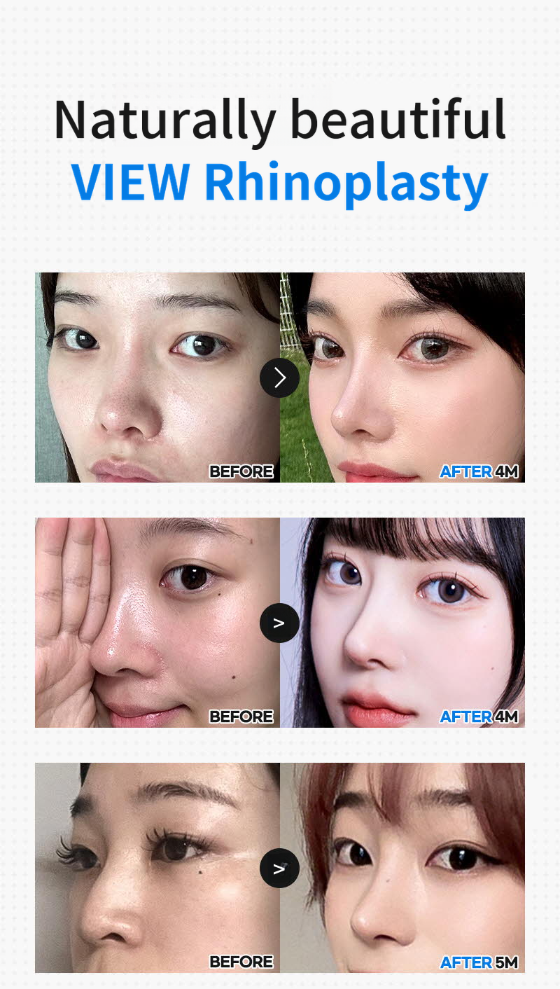 ❤️View❤️Nose Reshaping