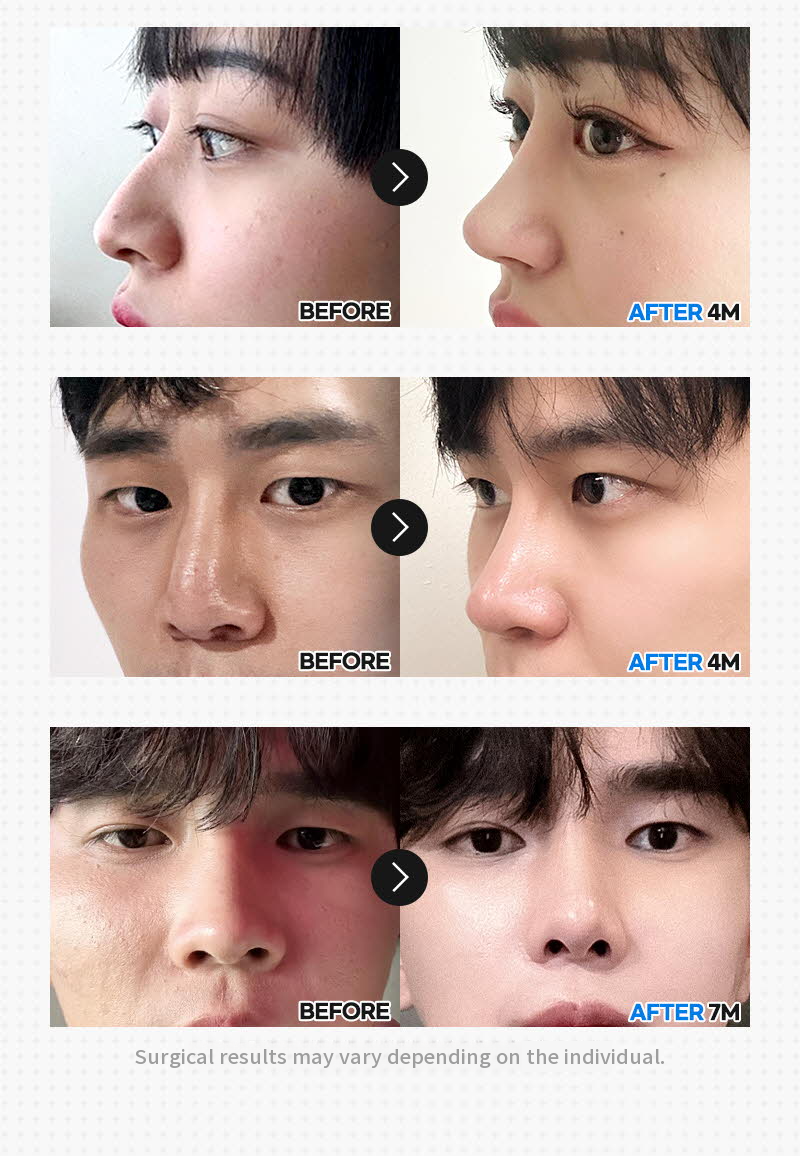 ❤️View❤️Nose Reshaping