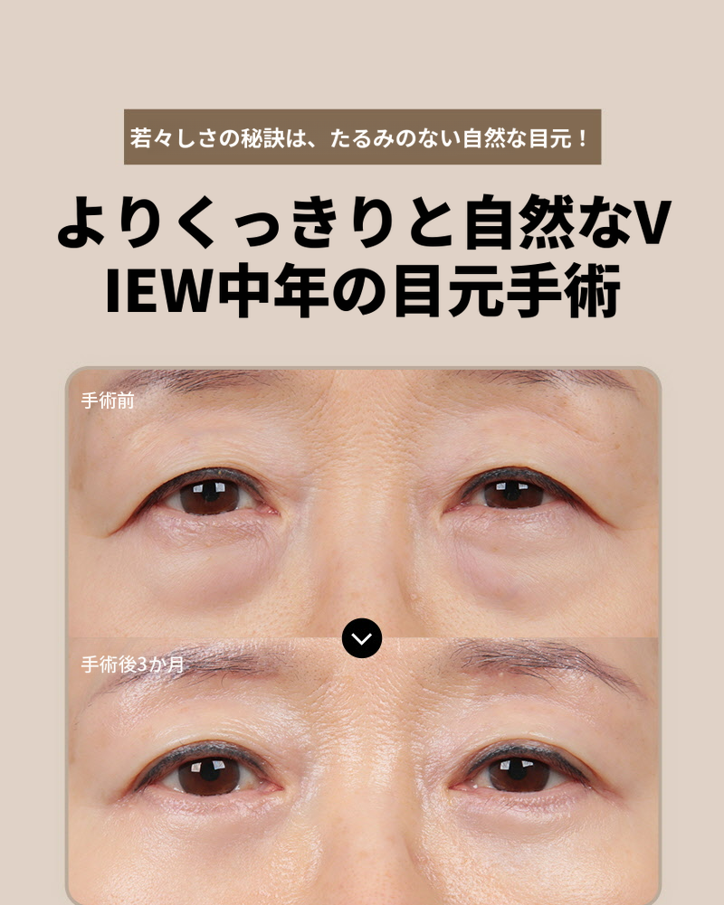 ❤️ビュー❤️眉毛リフト術