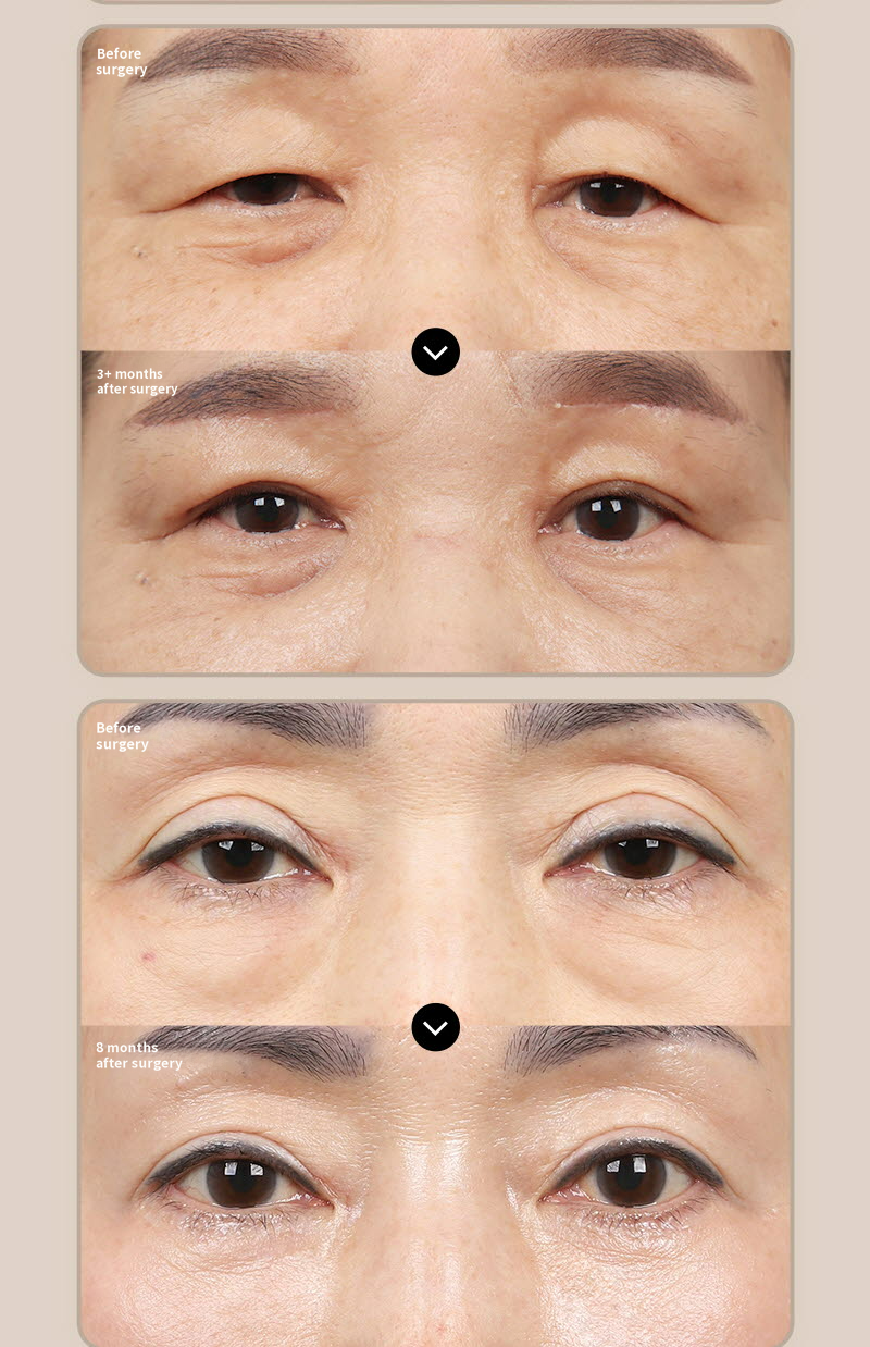 ❤️View❤️Eyebrow Lift Surgery