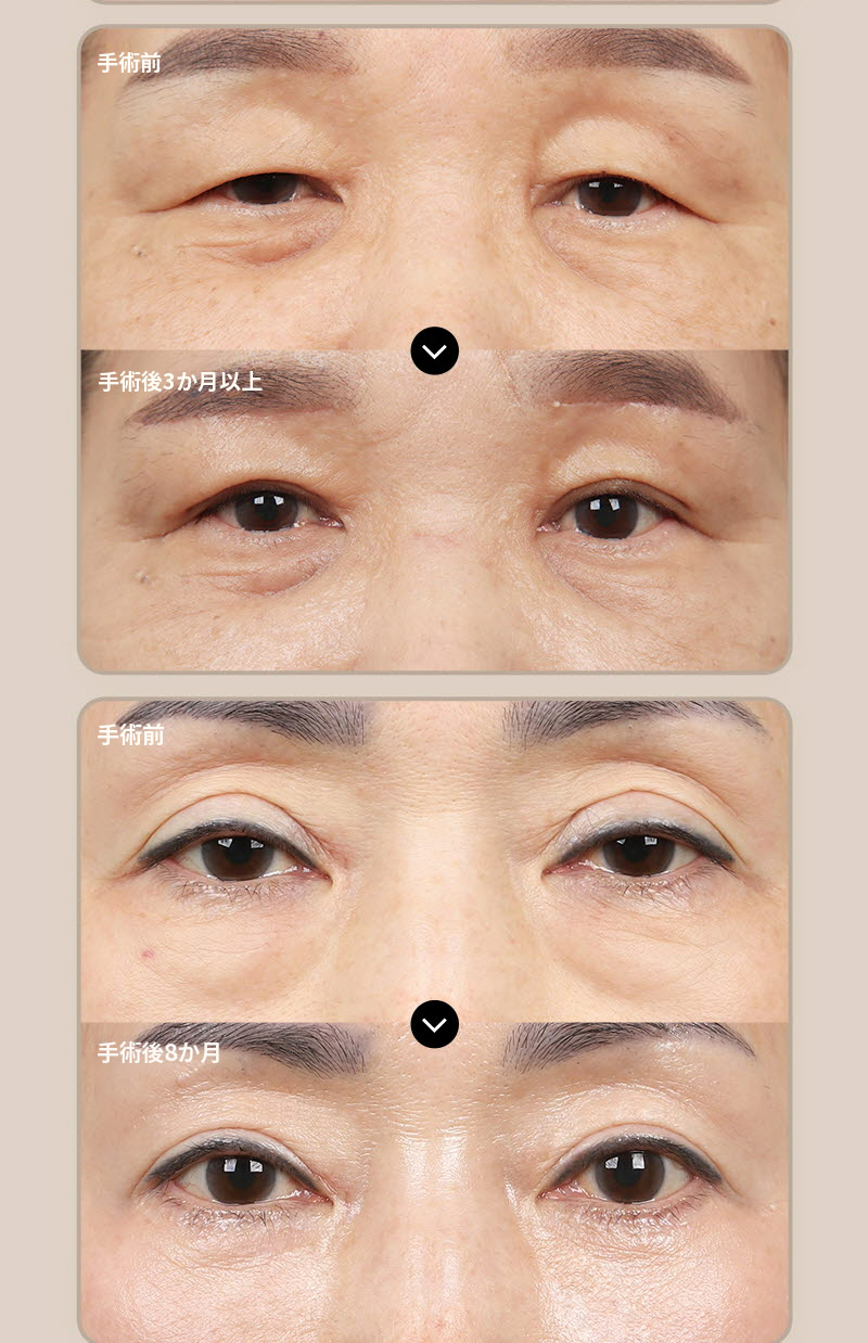 ❤️ビュー❤️眉毛リフト術