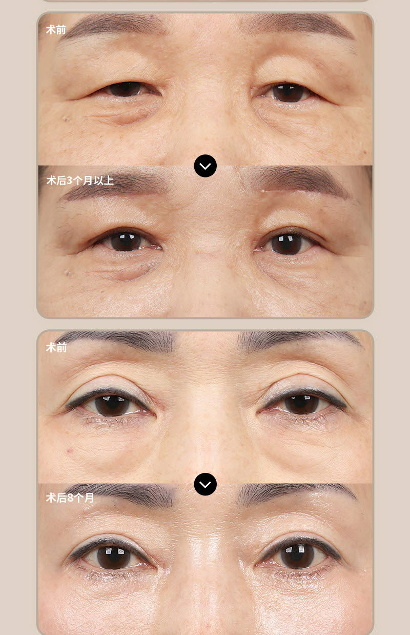 ❤️眉毛提拉术❤️