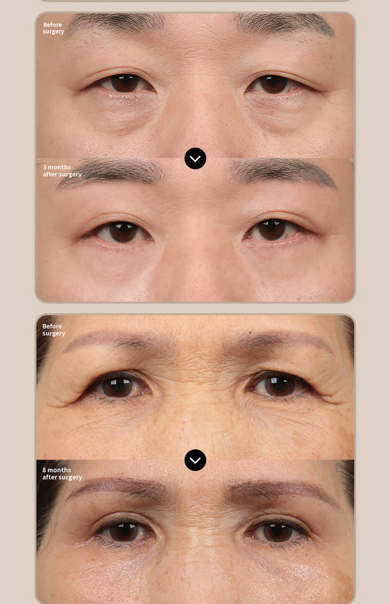 ❤️View❤️Eyebrow Lift Surgery