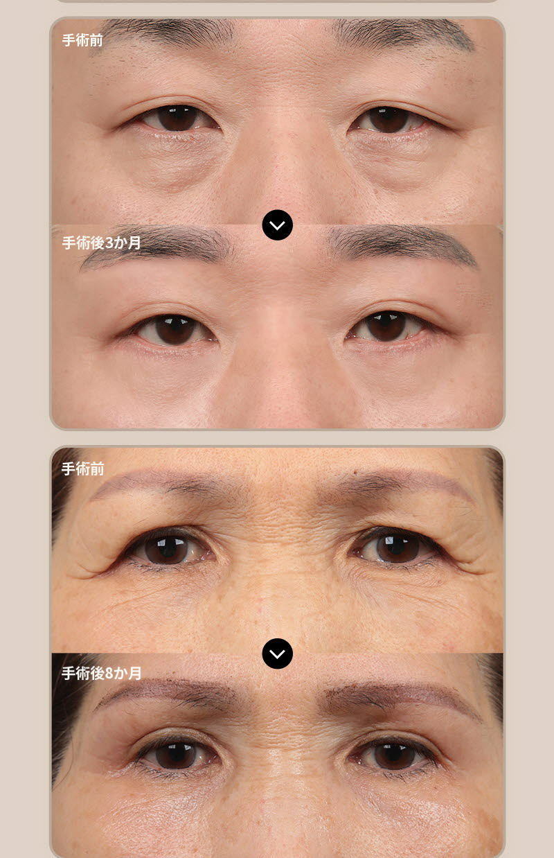 ❤️ビュー❤️眉毛リフト術