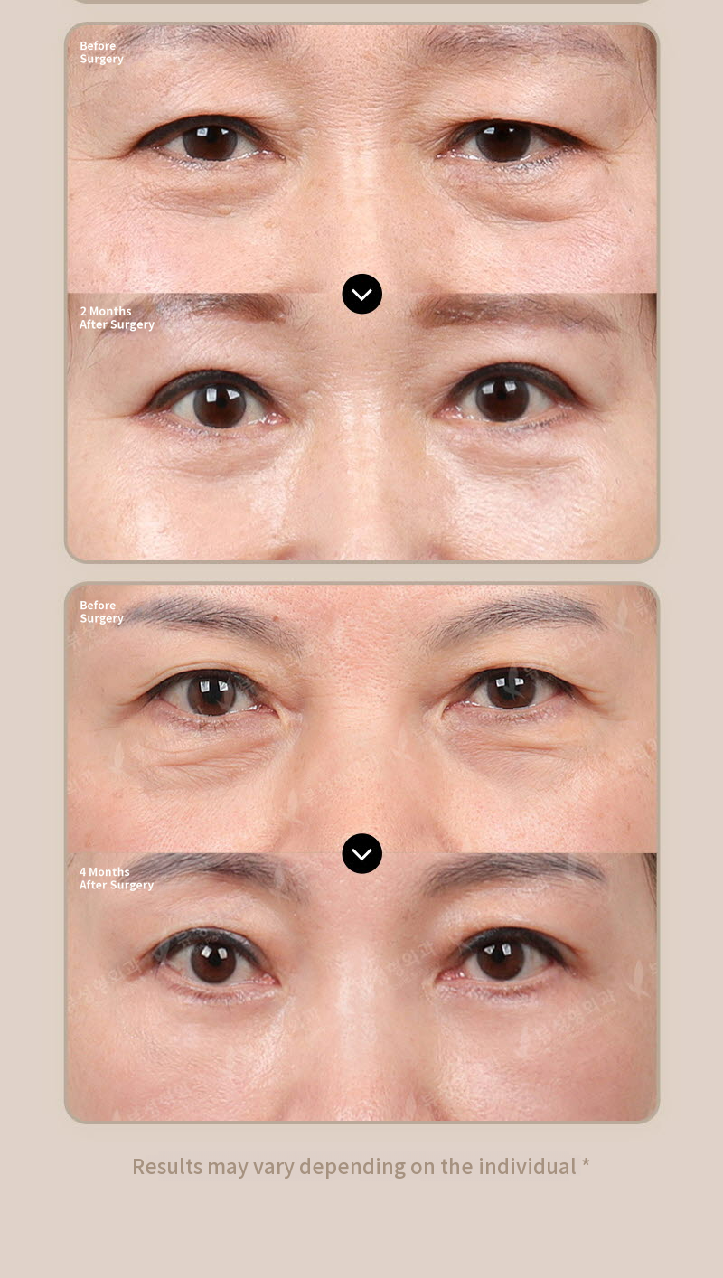 ❤️View❤️Eyebrow Lift Surgery