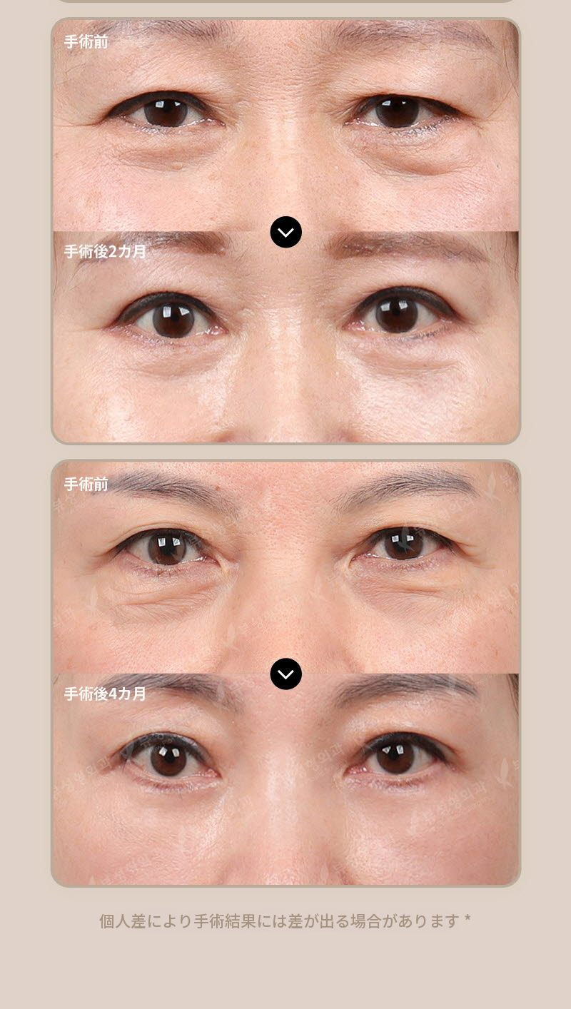 ❤️ビュー❤️眉毛リフト術