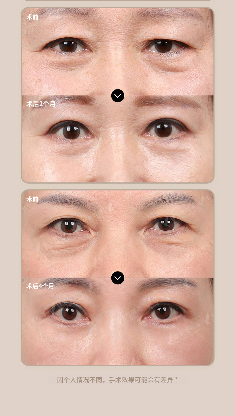 ❤️眉毛提拉术❤️