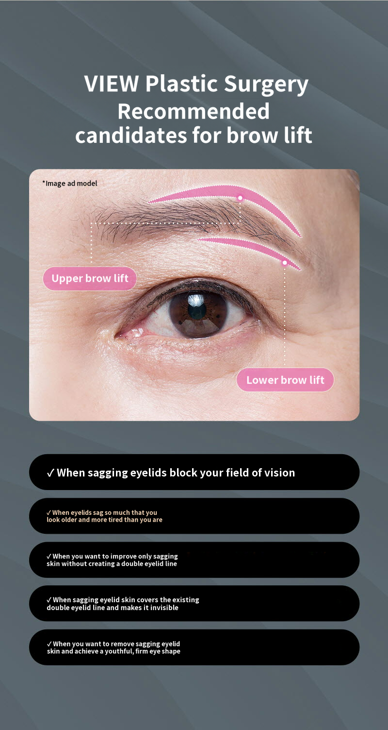 ❤️View❤️Eyebrow Lift Surgery