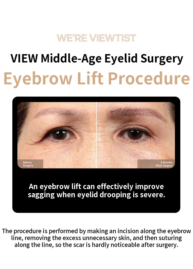 ❤️View❤️Eyebrow Lift Surgery