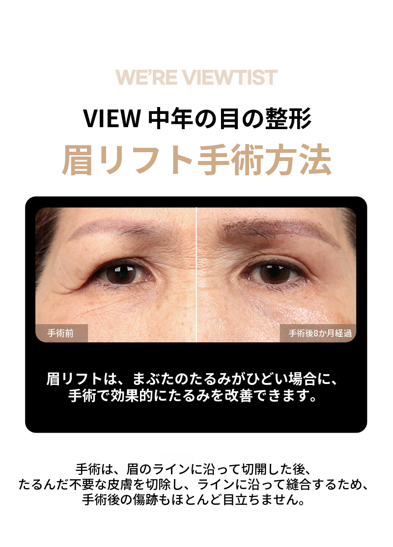 ❤️ビュー❤️眉毛リフト術