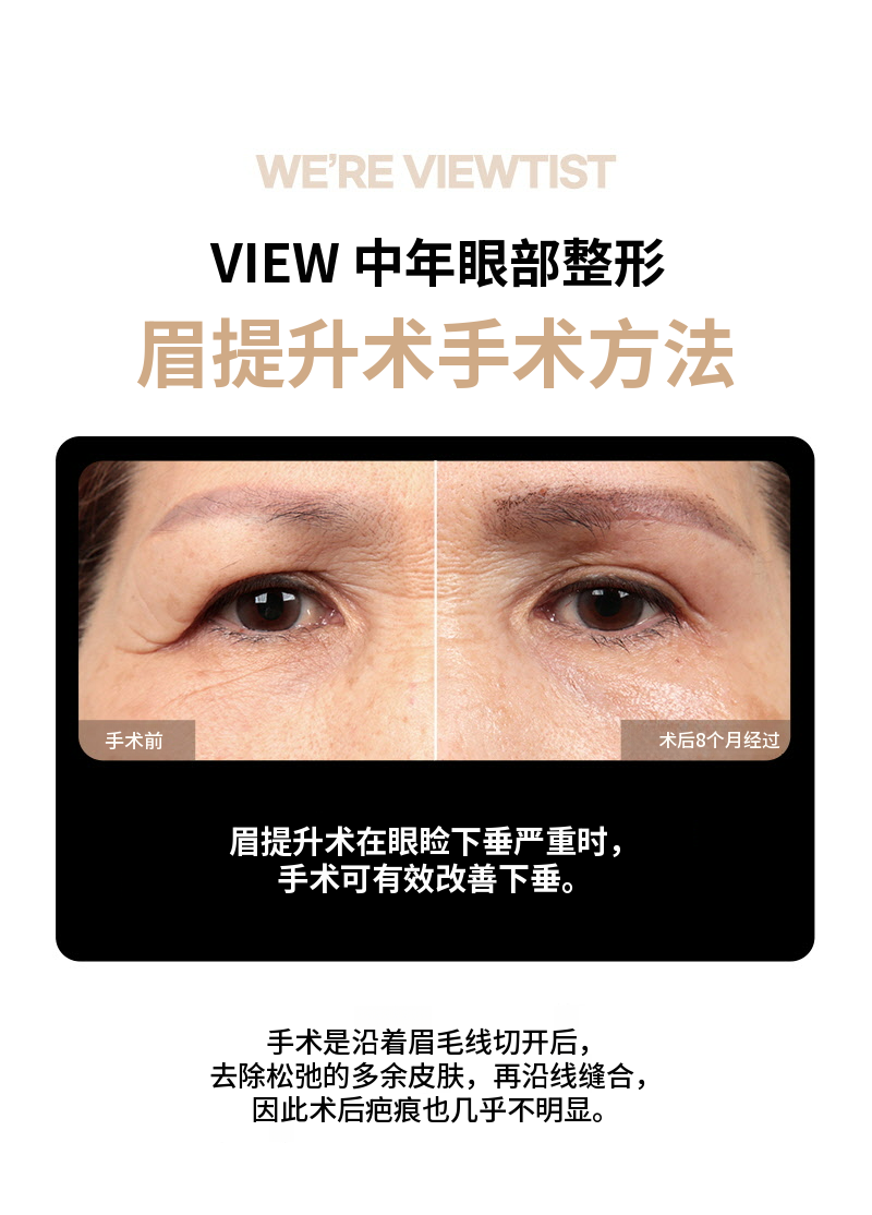 ❤️眉毛提拉术❤️