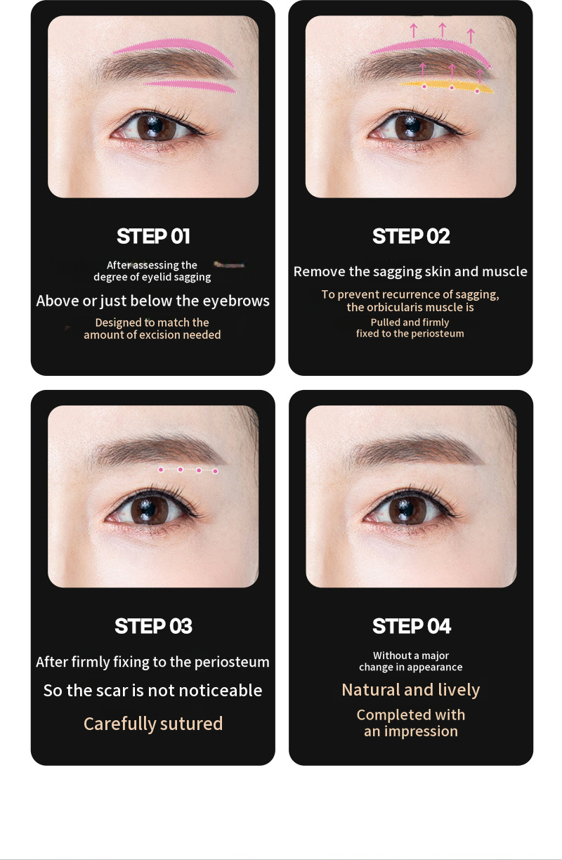 ❤️View❤️Eyebrow Lift Surgery