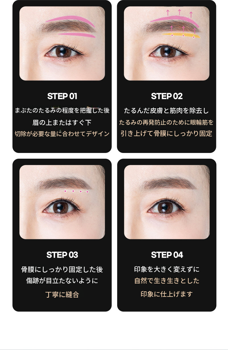 ❤️ビュー❤️眉毛リフト術