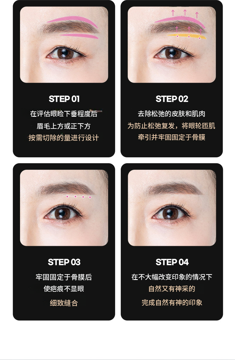 ❤️眉毛提拉术❤️