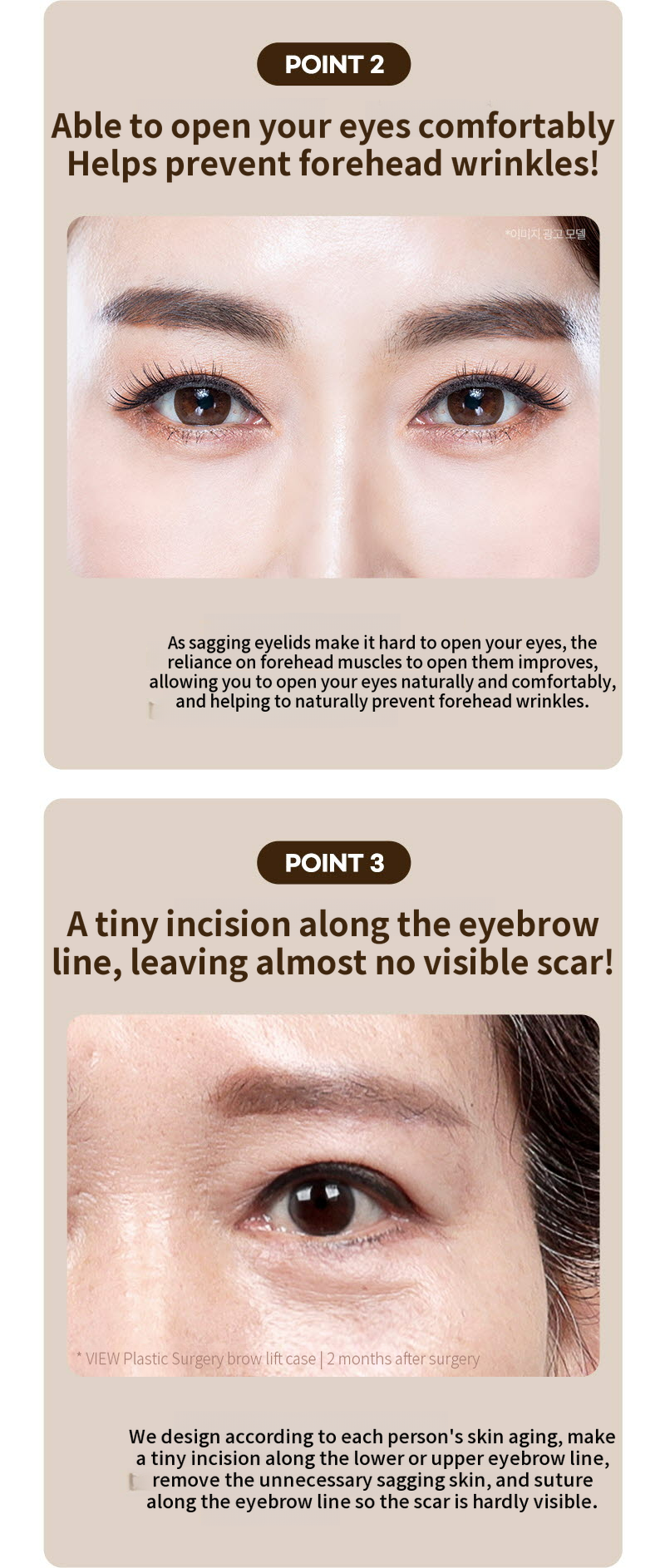 ❤️View❤️Eyebrow Lift Surgery