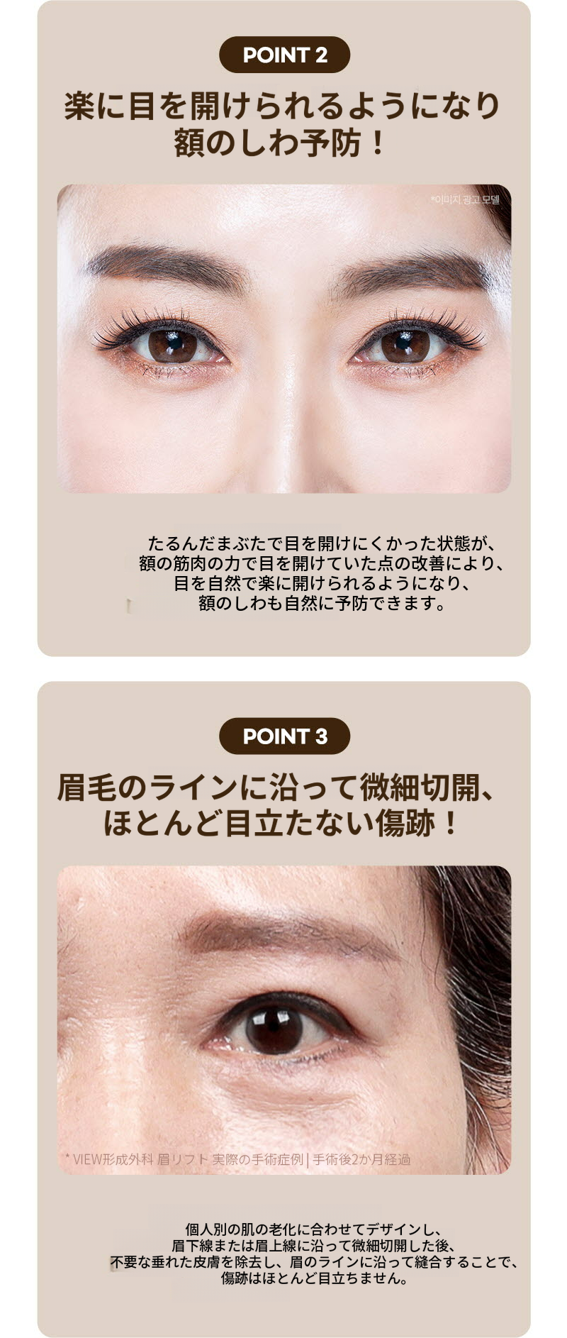 ❤️ビュー❤️眉毛リフト術