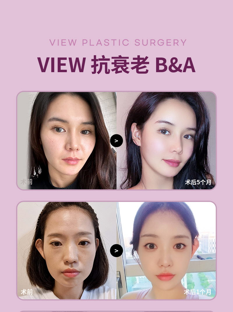❤视图❤迷你提拉