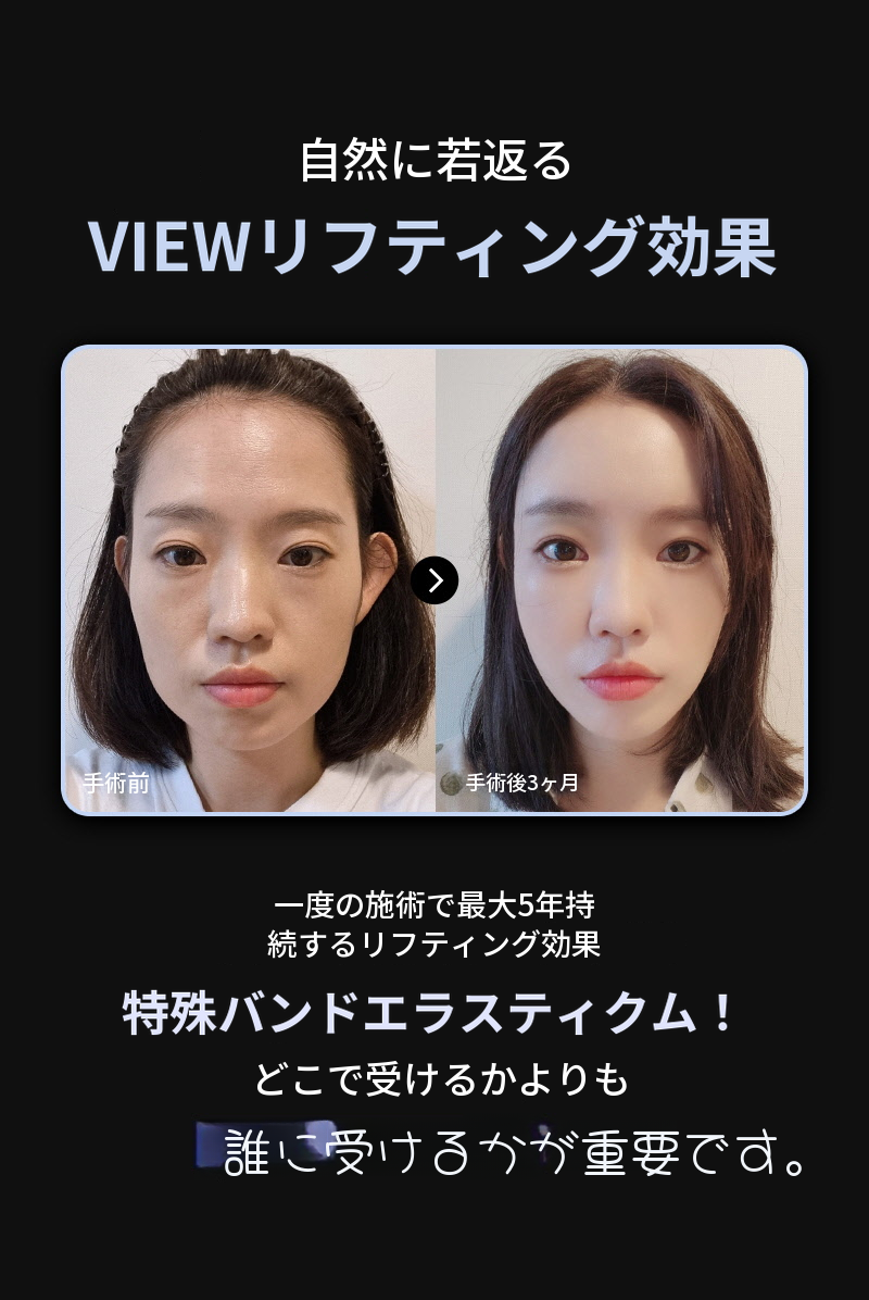 ❤️ビュ❤️エラストキュム糸リフティング