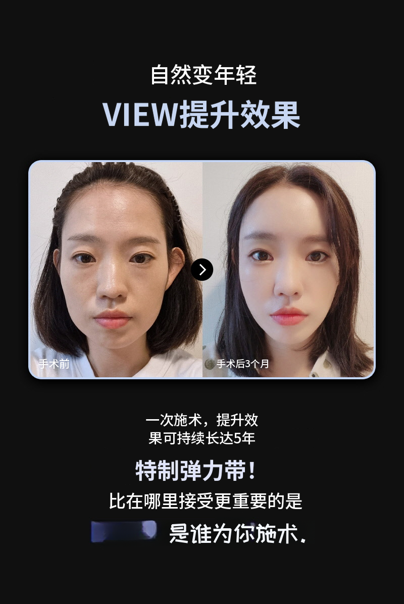 ❤️美视❤️弹性线提升
