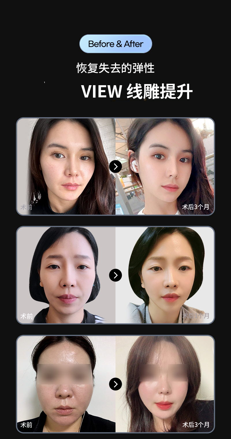 ❤️美视❤️弹性线提升