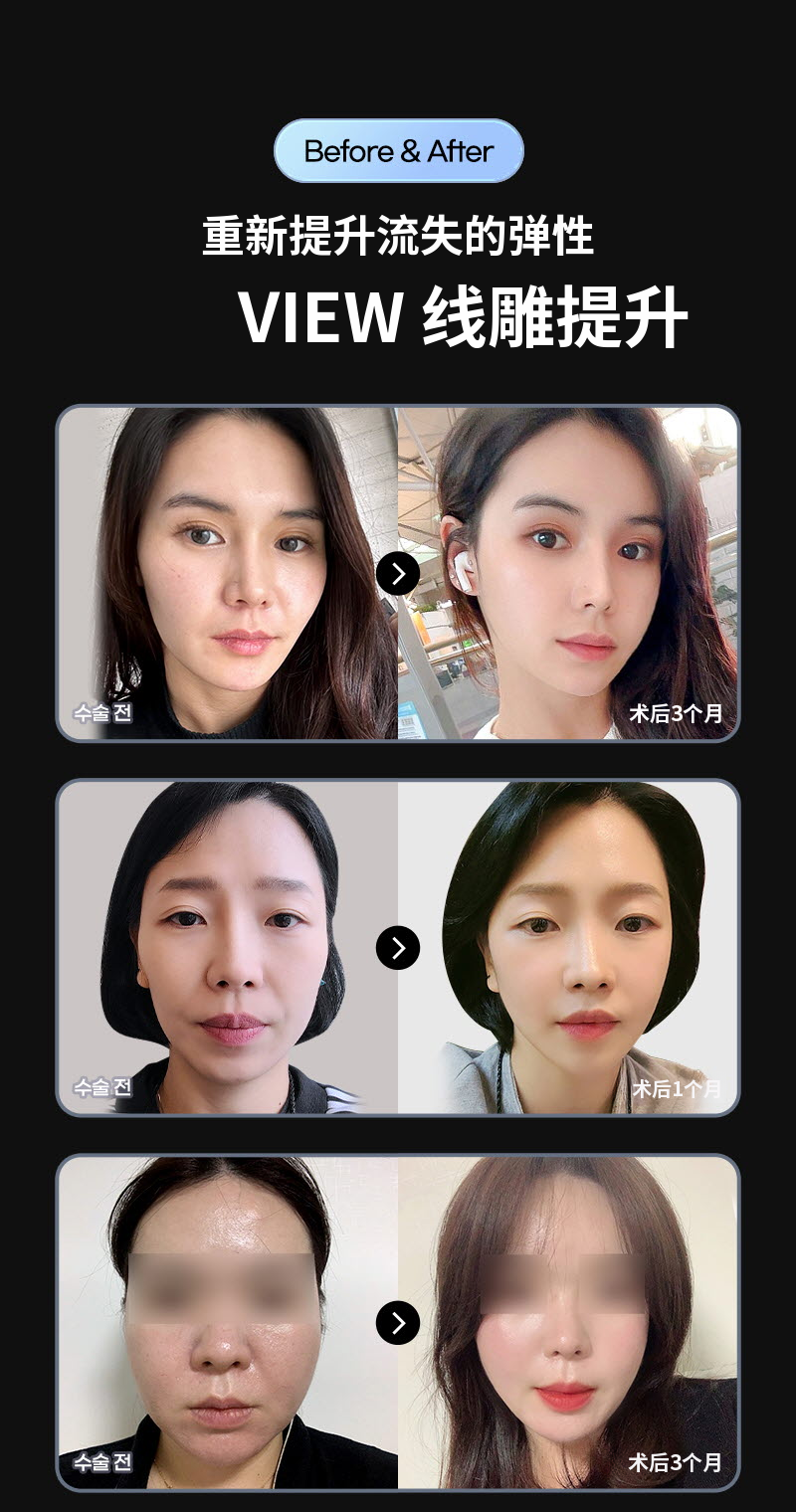 ❤视图❤弹性梦 硅胶提升