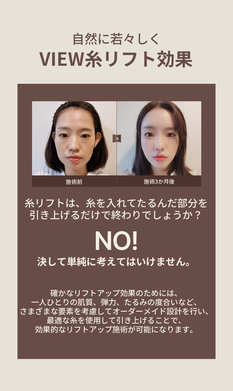 ❤ビュー❤糸リフト