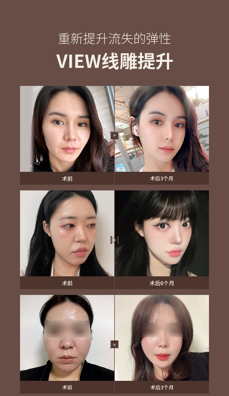 ❤维❤埋线提升