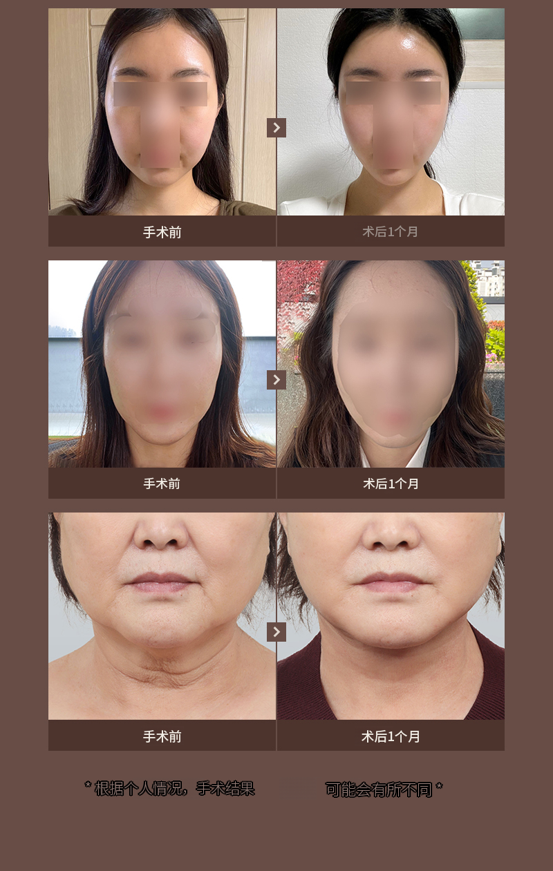 ❤维❤埋线提升