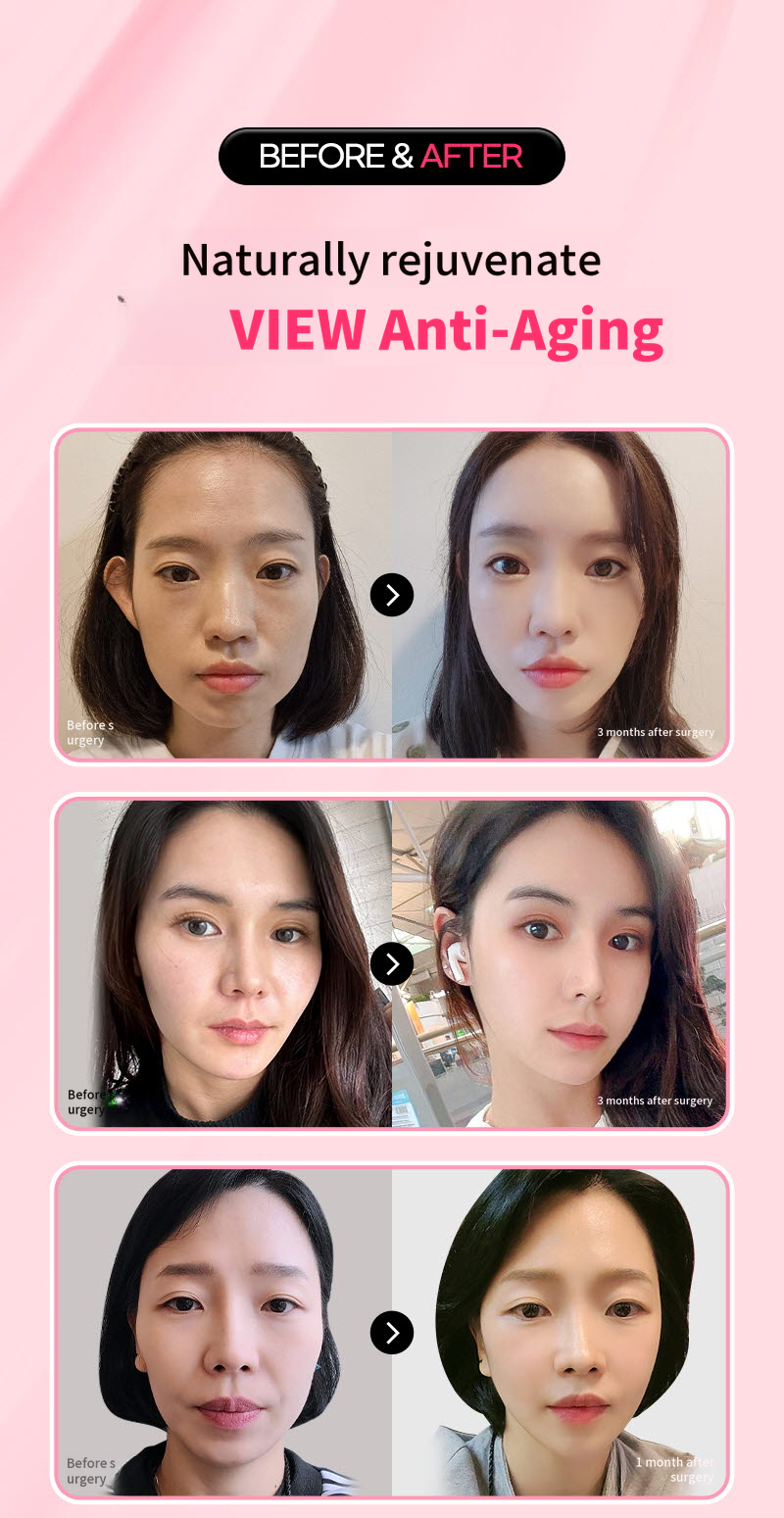 ❤️View❤️ Thermage FLX Lifting