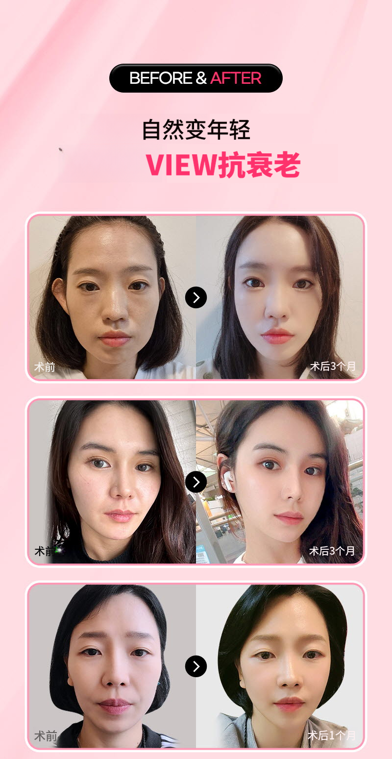 ❤️美视❤️热玛吉FLX提升