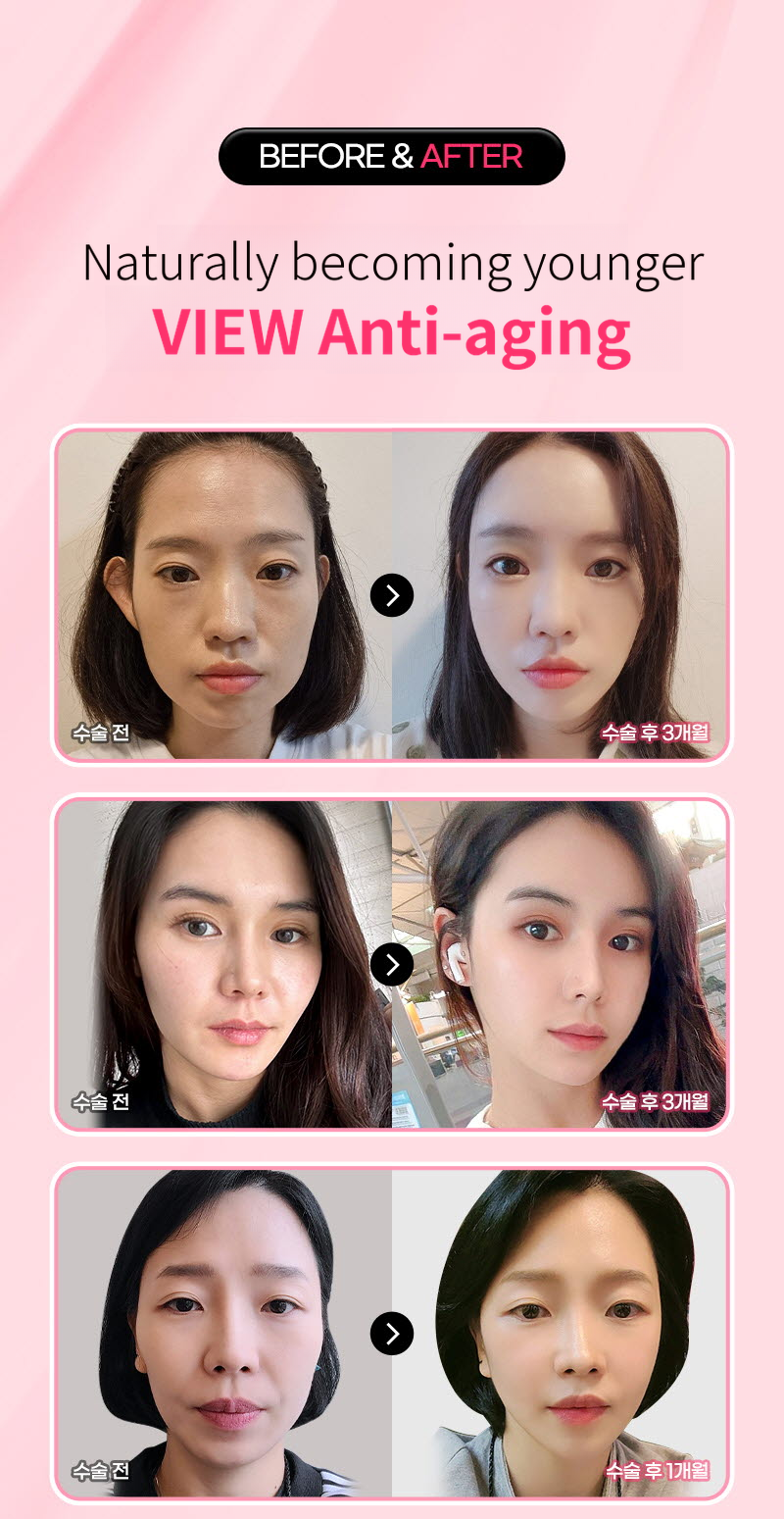 ❤View❤Thermage FLX Lifting