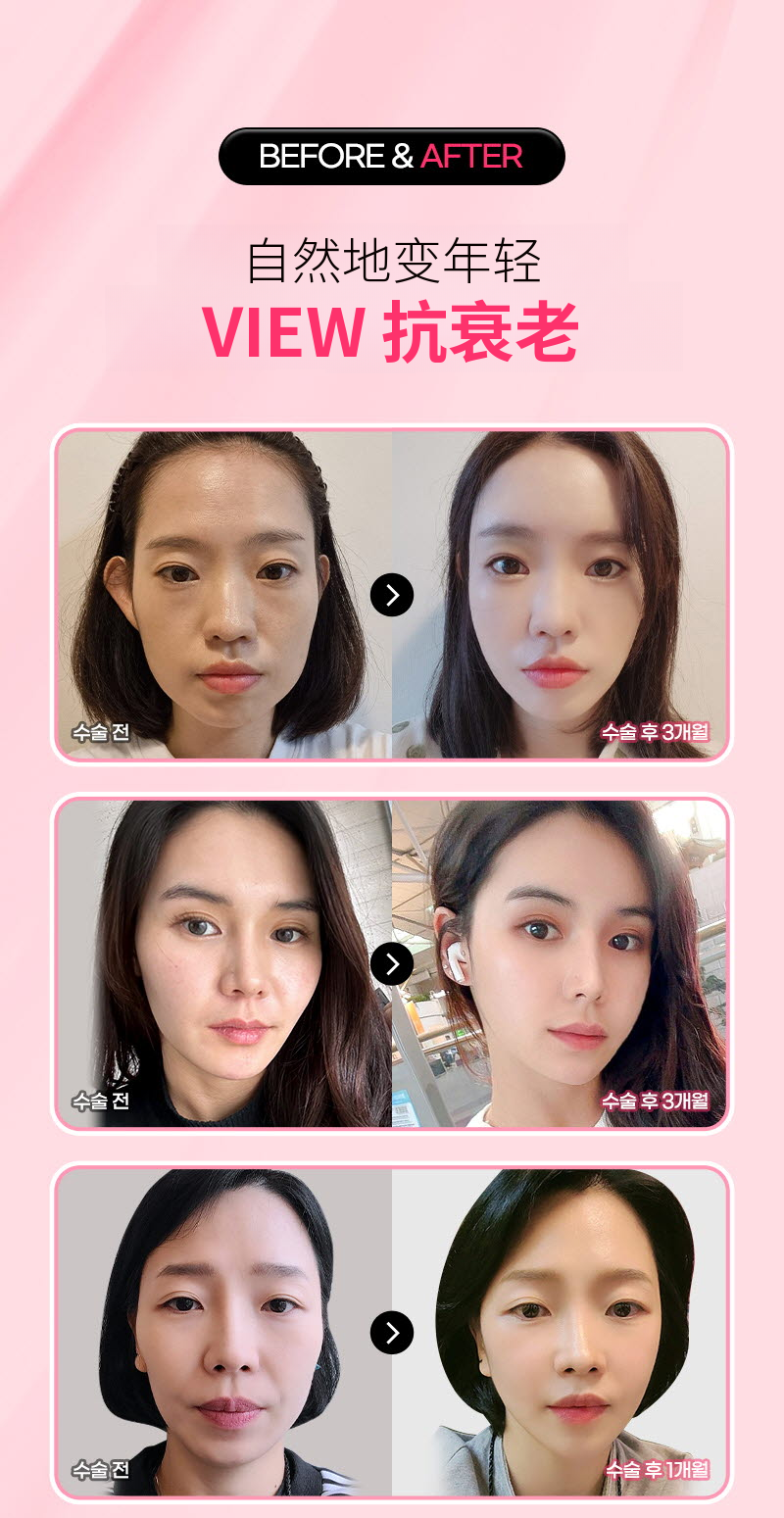❤视❤舒瑞美 FLX 提拉